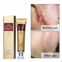 Acne and Scar Removal Gel - Golonzo -                                                                             