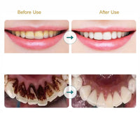 Electric Sonic Dental Calculus Scaler For Oral Teeth Tartar Remover - Golonzo -                                                                             